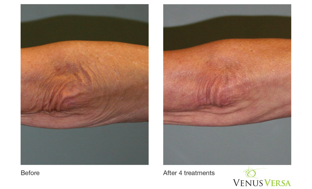 Elbow Wrinkles Reduction