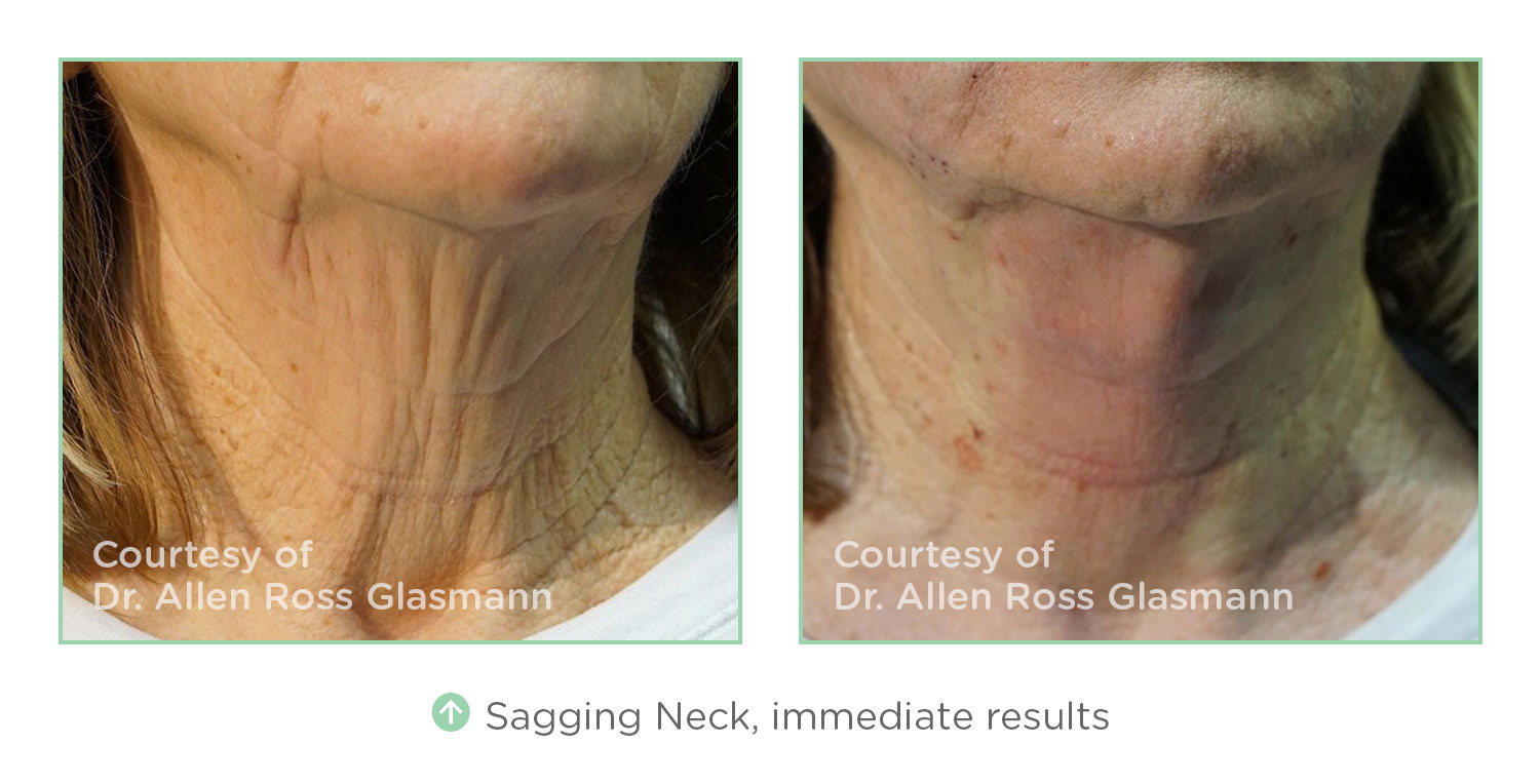 NovaThreads Sagging Neck - Courtesy of Dr. Allen Ross Glasmann