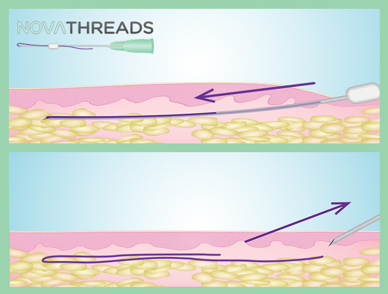 Dissolvable PDO Threads