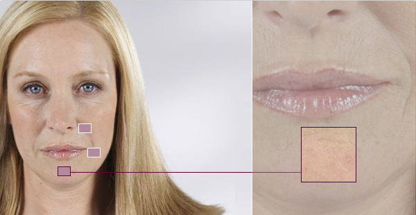 Sculptra Chin Lines