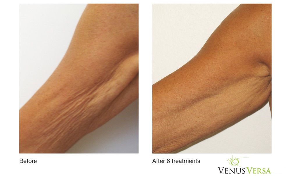 Arm Wrinkle Reduction